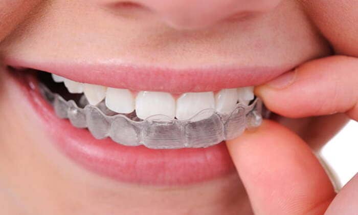 تقويم-الاسنان-الشفاف