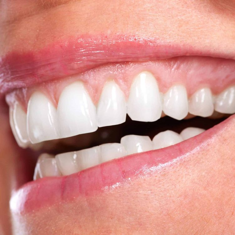 قص اللثة بالليزر